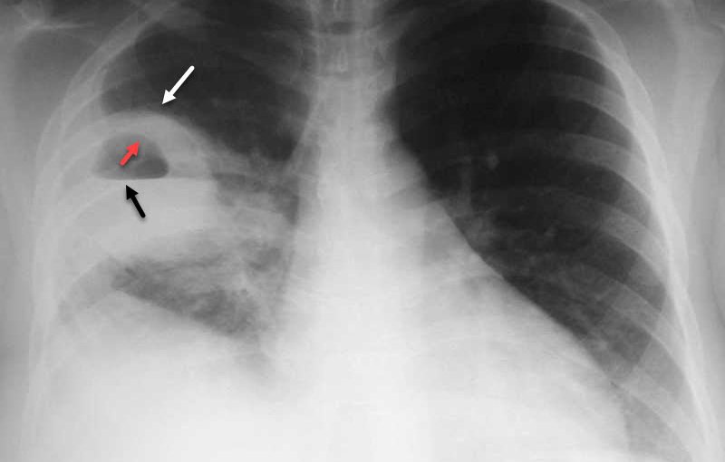 Trẻ nhiễm virus hợp bào hô hấp đang gia tăng2