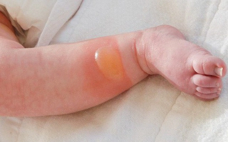 Trẻ sơ sinh bị muỗi đốt mưng mủ có nguy hiểm không 1