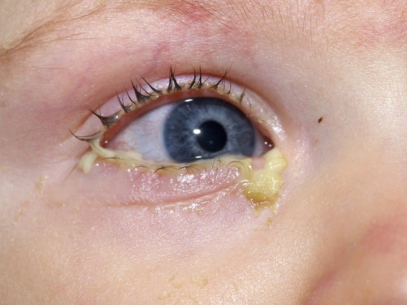 Trẻ sơ sinh mắt bị ghèn phải làm sao? 2