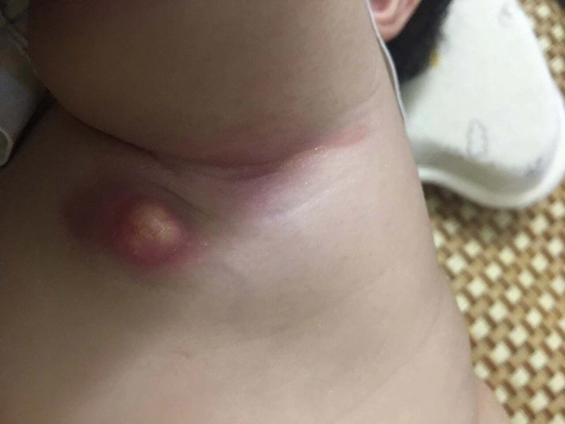 Trẻ tiêm phòng lao bị nổi hạch có nguy hiểm không 2