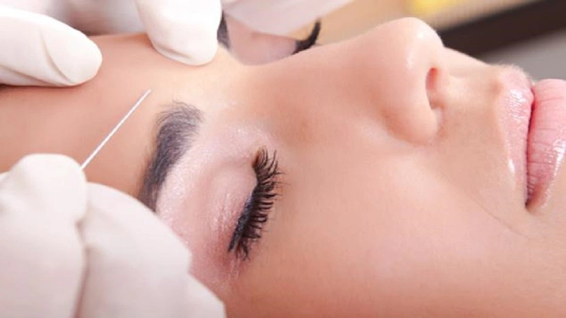 Hiện nay, có 2 phương pháp treo ch-n mày được sử dụng phổ biến nhất bao gồm phẫu thuật và treo bằng chỉ