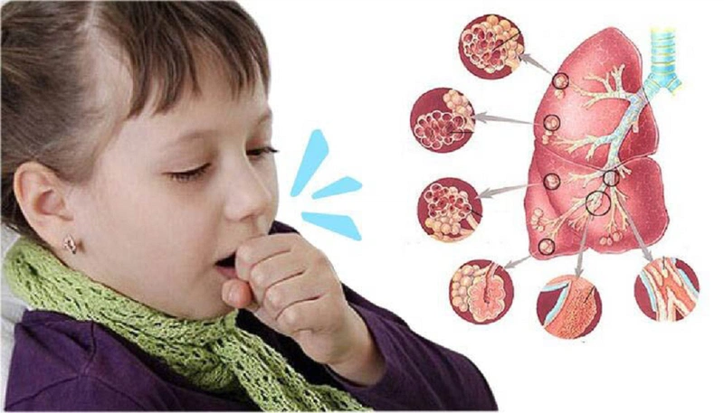 Bệnh ho gà nên uống thuốc gì điều trị hiệu quả? 2