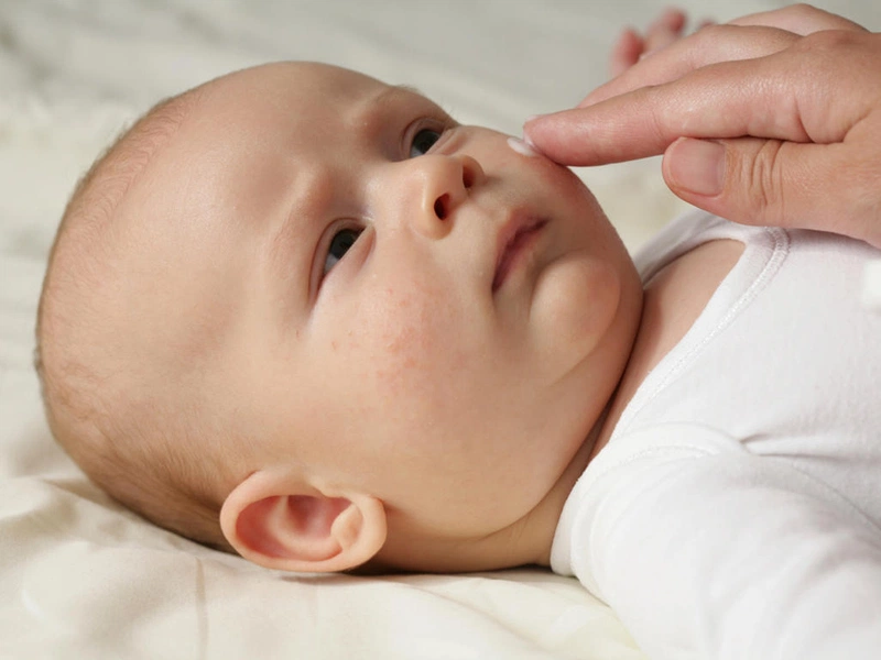 trị chàm sữa bằng sữa mẹ 5