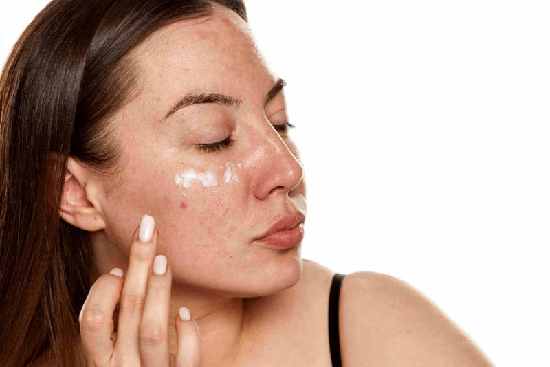 Trị đồi mồi sau sinh như thế nào? 4