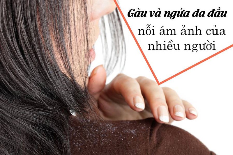 trị tóc gàu mảng 1
