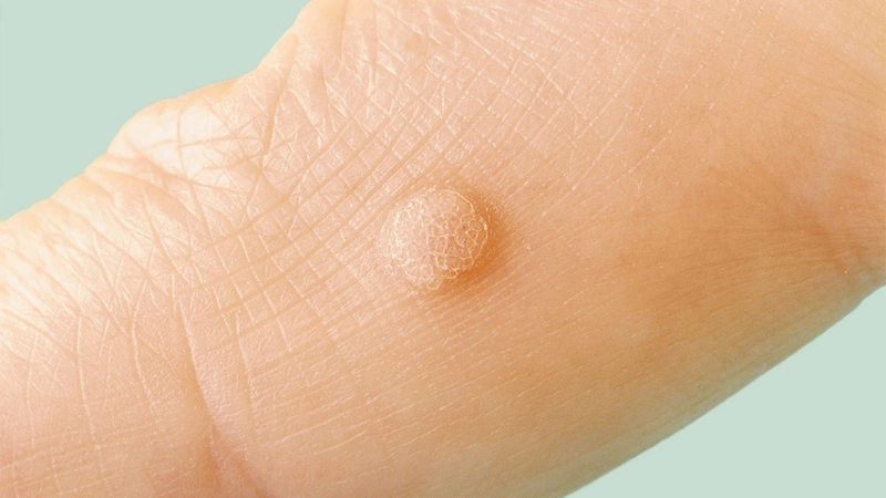 Trị mụn cóc bằng tỏi có hiệu quả không 2