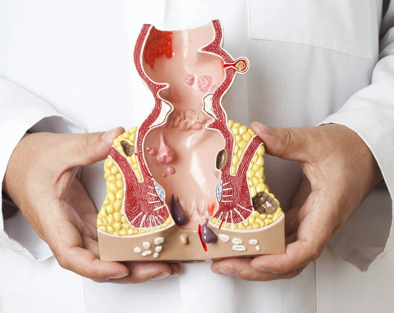 Trĩ nội độ 3 có cần phẫu thuật hay không?3