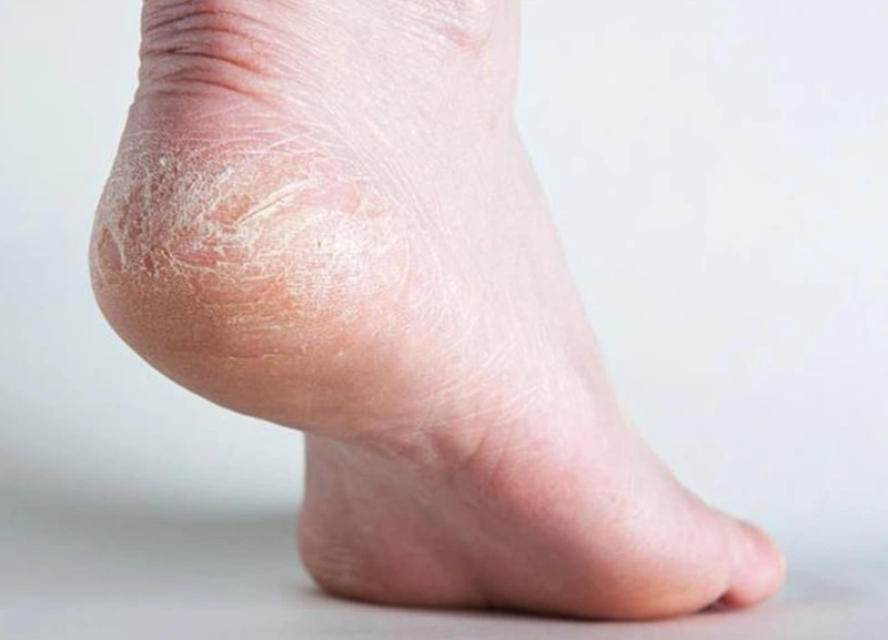 Trị nứt gót chân bằng dầu dừa làm mềm da, tránh tái phát bệnh 1