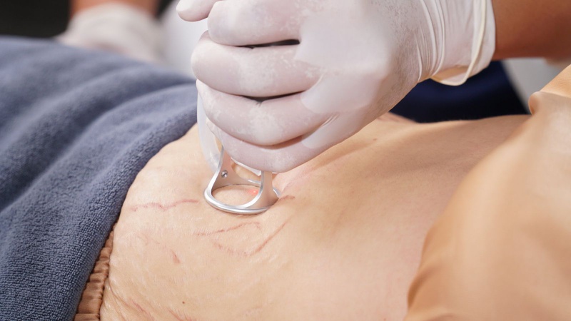 trị rạn da sau sinh bằng laser 1
