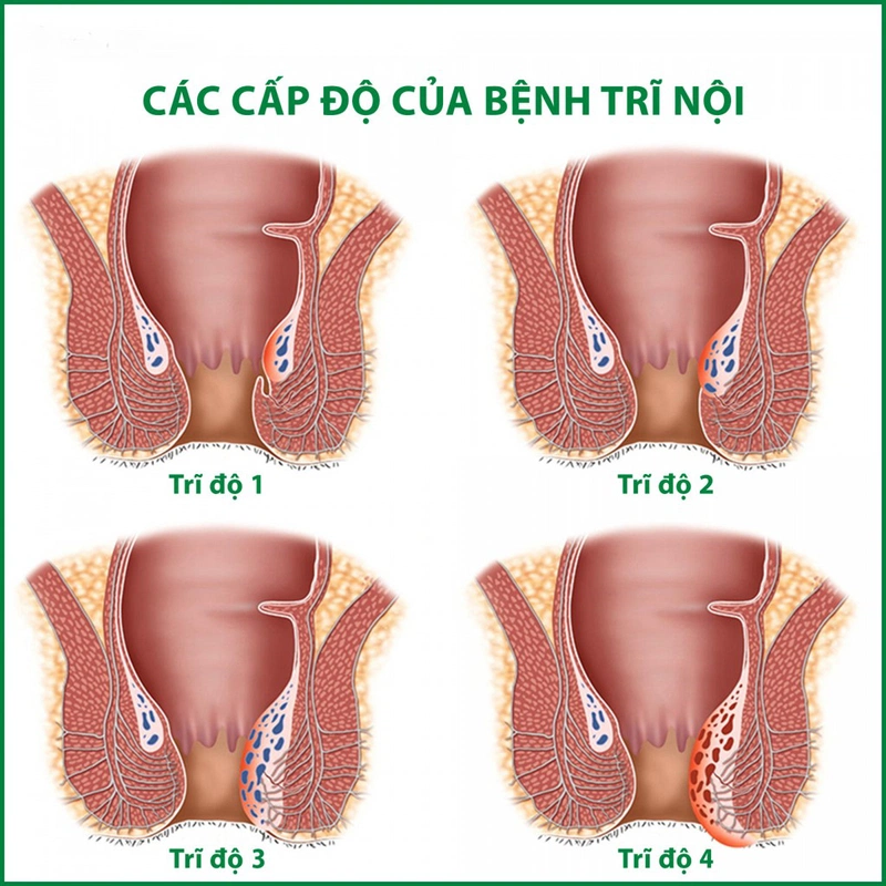 Bệnh trĩ sau sinh có tự khỏi không? Người bệnh cần làm gì? 2
