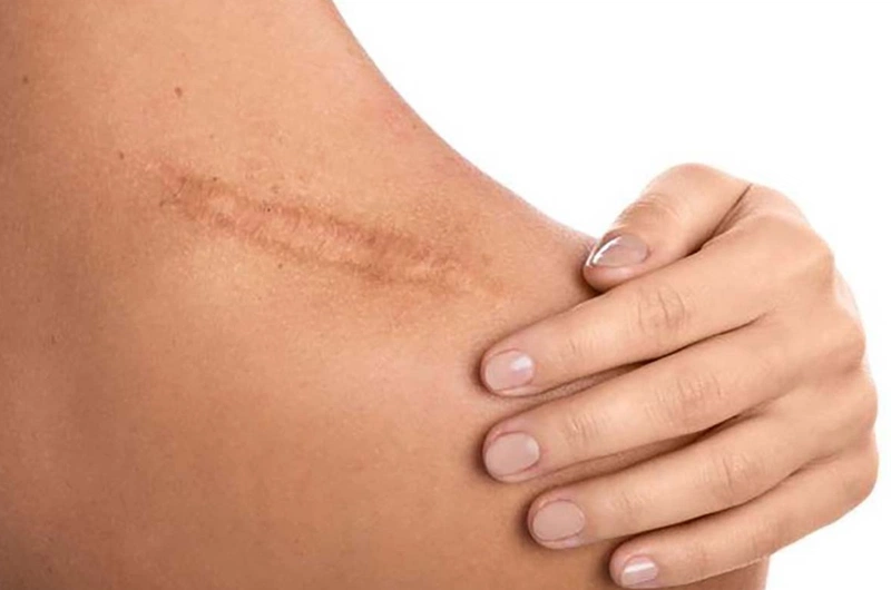 Trị sẹo bằng vitamin E có phải là phương pháp duy nhất? 1