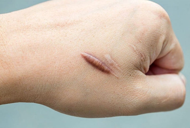 Hướng dẫn trị sẹo tại nhà hiệu quả 1