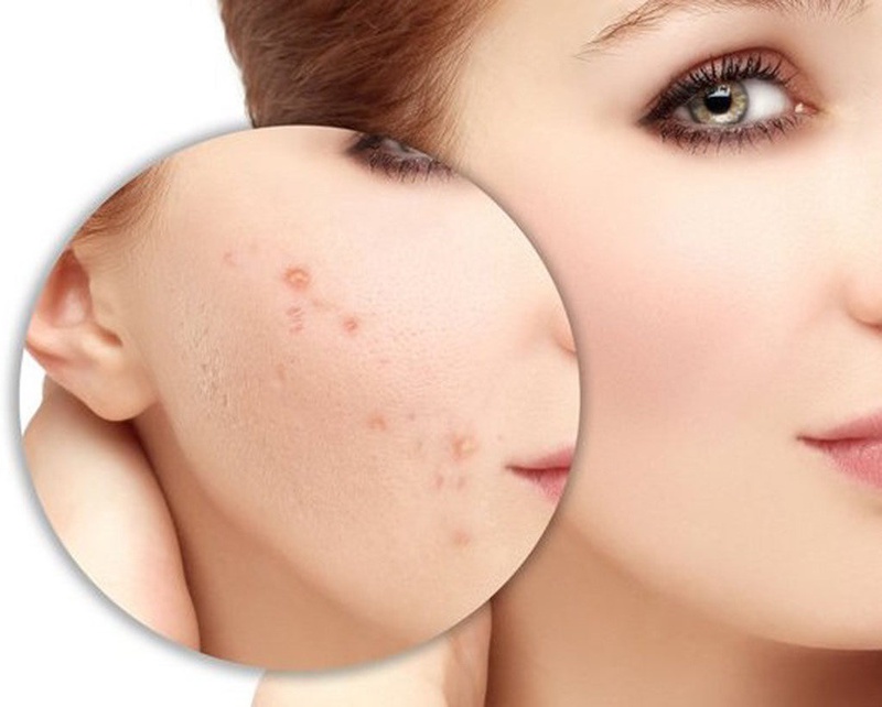 trị sẹo lõm bằng nghệ tươi 1