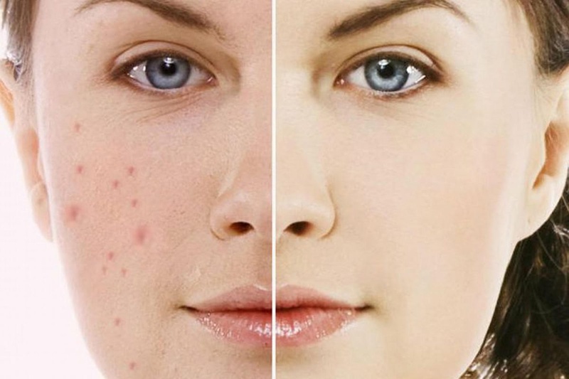 Trị thâm bằng Acnes C10 có hiệu quả không 1