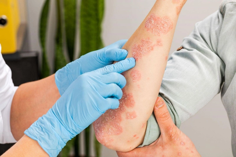 Trị viêm da cơ địa bằng lá ổi an toàn nhưng không thể áp dụng với trường hợp nặng
