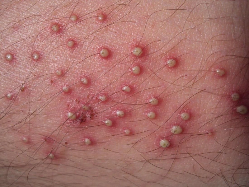 Trị viêm nang lông bằng bột yến mạch1