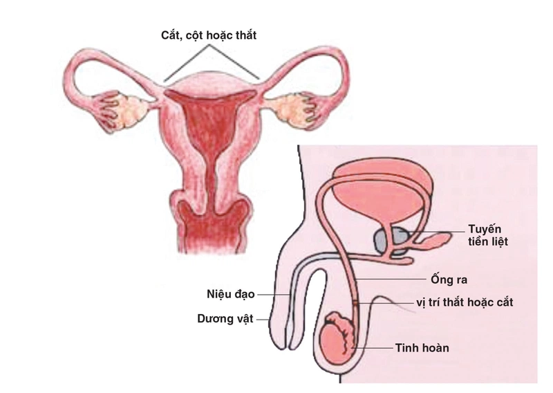 Triệt sản là gì? Nên triệt sản nam hay nữ giới? 1