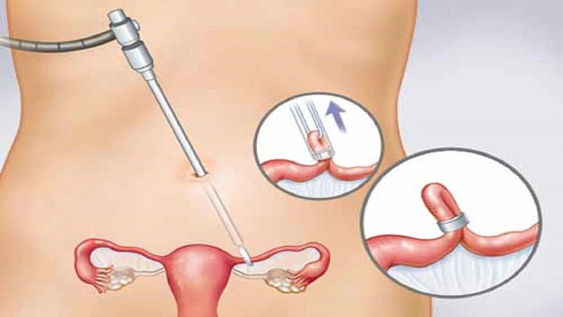 Triệt sản là gì? Nên triệt sản nam hay nữ giới? 3