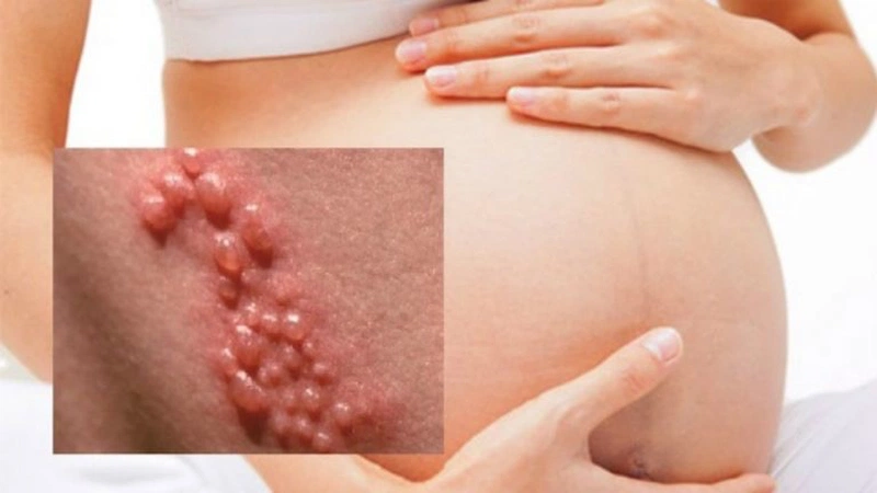 Triệu chứng bệnh lậu ở nữ giới bao gồm những gì? 3