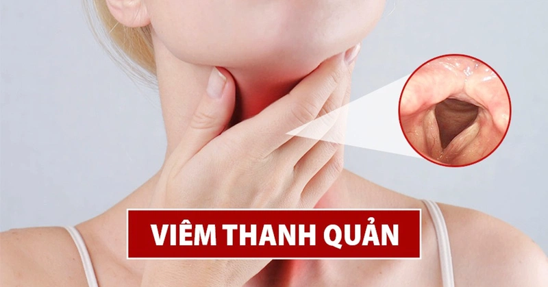 Triệu chứng bệnh viêm dây thanh quản 1