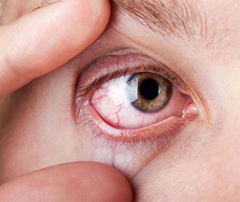 Triệu chứng đau mắt hột và những điều cần biết 2