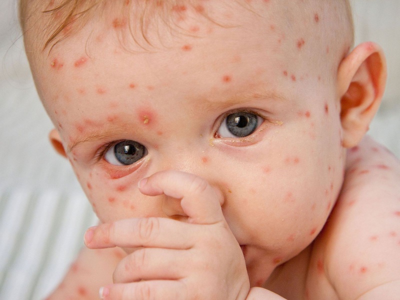 là một loại bệnh do virus gây nên và thường xuyên xảy ra vào mùa xuân 2