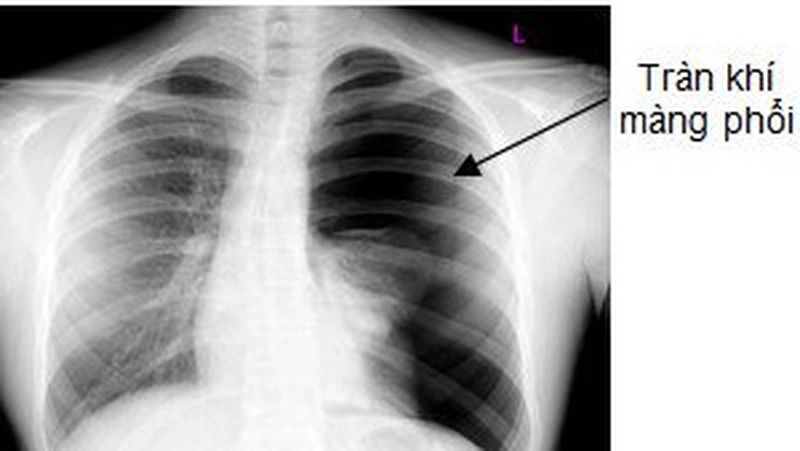 Triệu chứng tràn khí màng phổi được chẩn đoán và điều trị như thế ...