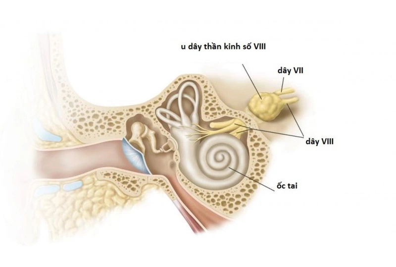 Triệu chứng u dây thần kinh số 8 gây ra là gì? Cách điều trị1