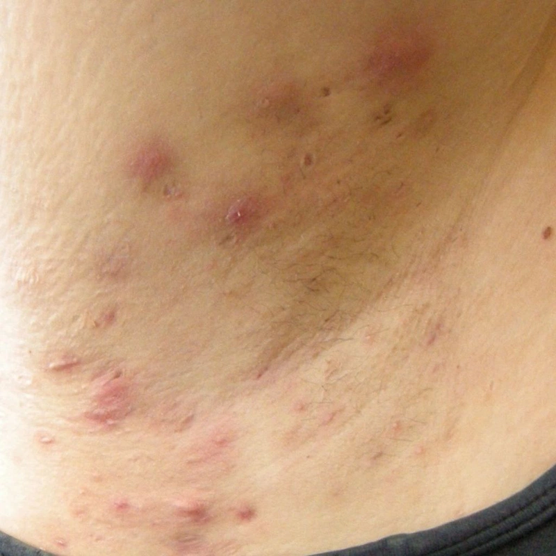 Triệu chứng viêm tuyến mồ hôi mủ là gì? Cách điều trị viêm tuyến mồ hôi mủ mà bạn nên biết 1