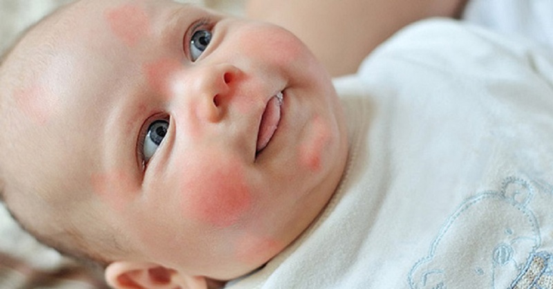 Nguyên nhân và cách điều trị bệnh tăng nhãn áp ở trẻ em 2