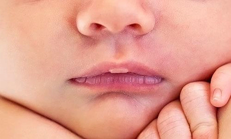 Góc mỗi ngày một lưu ý: Cần làm gì khi trẻ sơ sinh bị rộp trắng ở môi 1