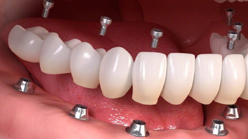 Trồng răng bằng cấy ghép implant có thật sự tốt? 3