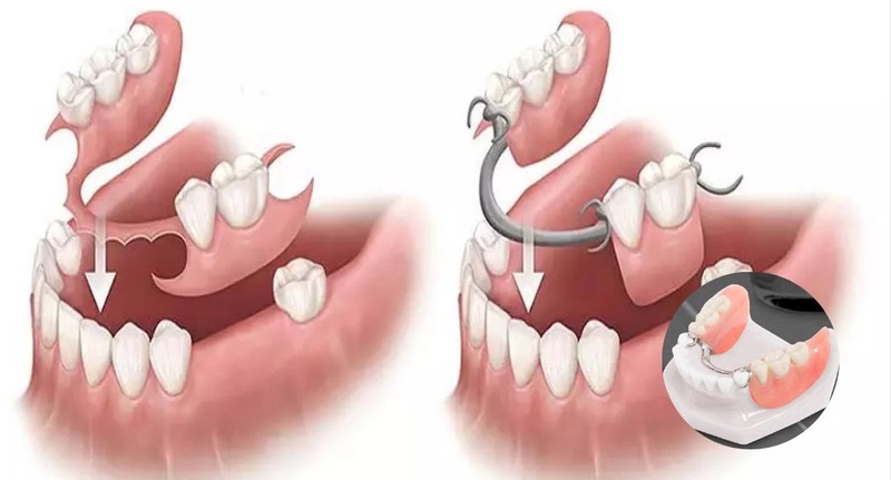 Trồng răng có đau không? Các phương pháp trồng răng hiệu quả hiện nay 2