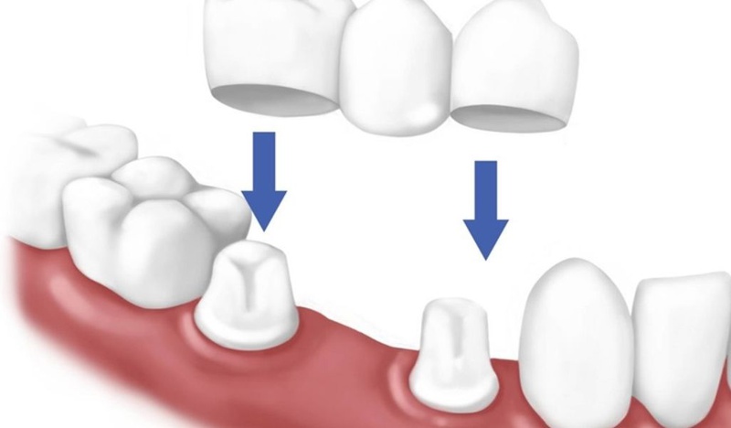 Trồng răng có đau không? Các phương pháp trồng răng hiệu quả hiện nay 3