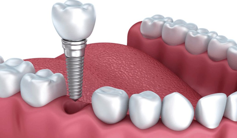 Trồng răng có đau không? Các phương pháp trồng răng hiệu quả hiện nay 4