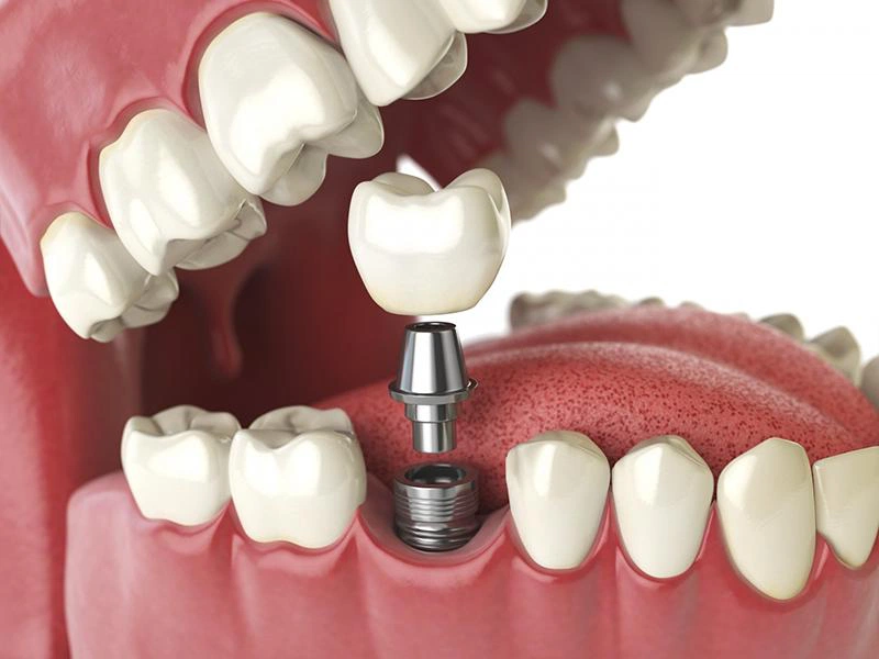 Trồng răng implant có chụp MRI được không?-2