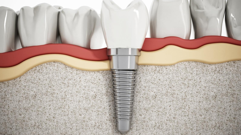 Trồng răng Implant có đau không? 3