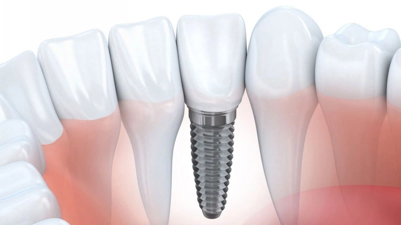 Trồng răng implant giá bao nhiêu? 3