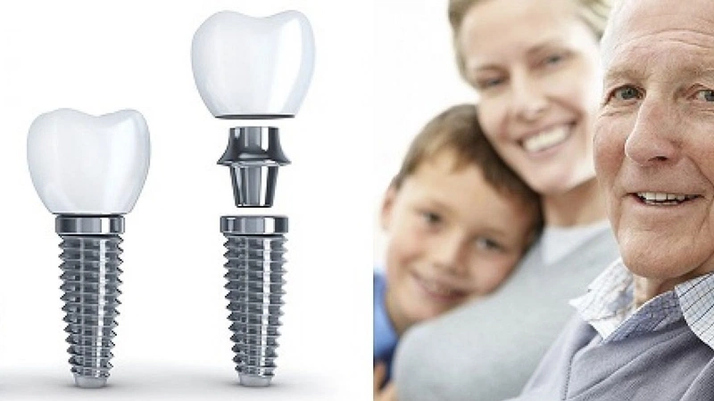 Trồng răng implant giá bao nhiêu? 2