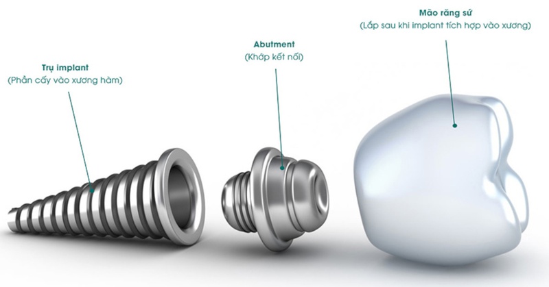 Trồng răng implant mất bao lâu? Sau khi trồng răng implant khi nào thì ăn được? 2