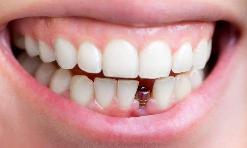 Trồng răng implant là gì? Những lưu ý khi trồng răng implant 1
