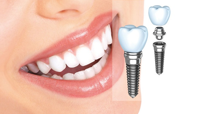 Trồng răng implant là gì? Những lưu ý khi trồng răng implant 4