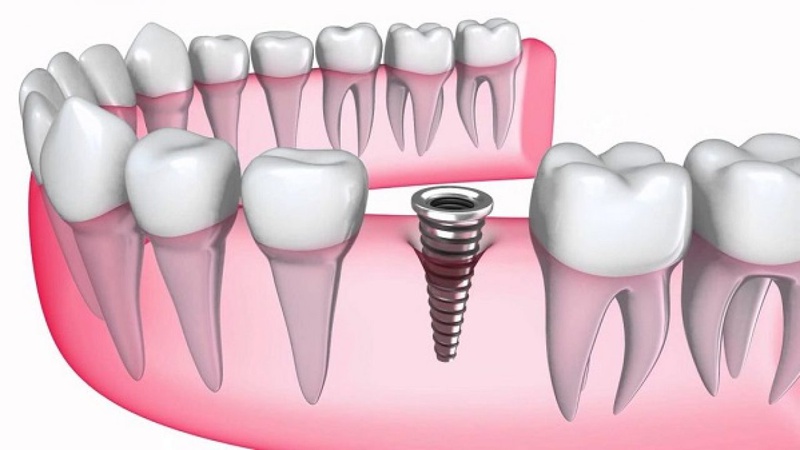Trồng răng implant mất bao lâu? Sau khi trồng răng implant khi nào thì ăn được? 1