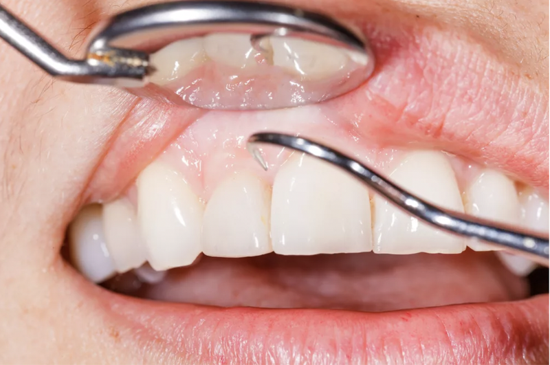 Trồng răng implant mất bao lâu? Sau khi trồng răng implant khi nào thì ăn được? 3