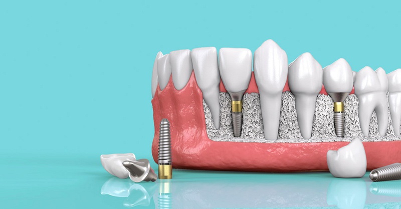 Lưu ý khi trồng răng ở người cao tuổi 1
