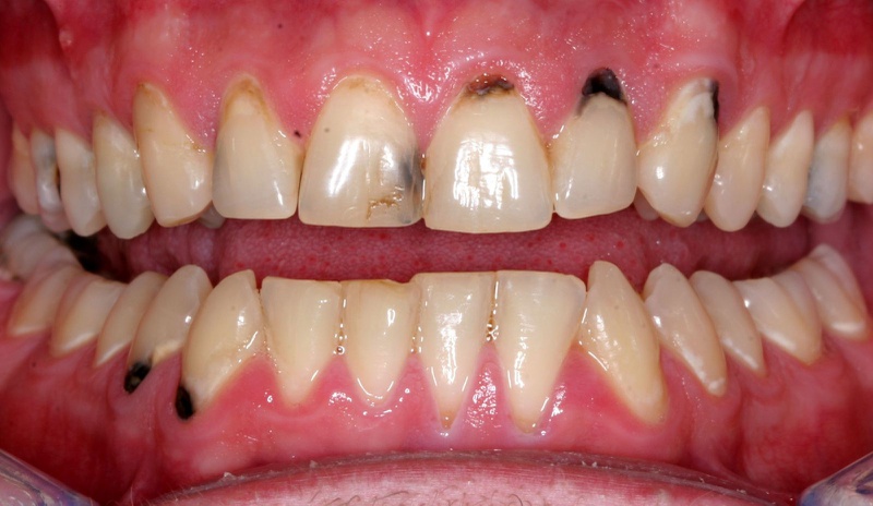 Trồng răng sứ là gì? Cách chăm sóc răng miệng sau khi trồng sứ như thế nào? 3