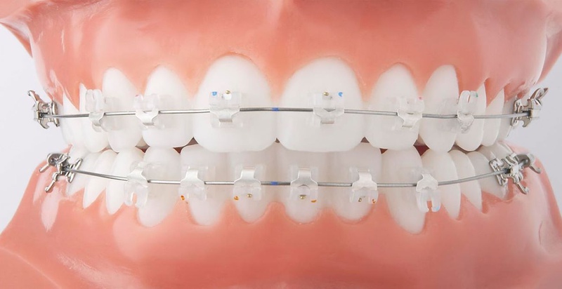 Trước và sau niềng răng có những thay đổi tích cực như thế nào? 1