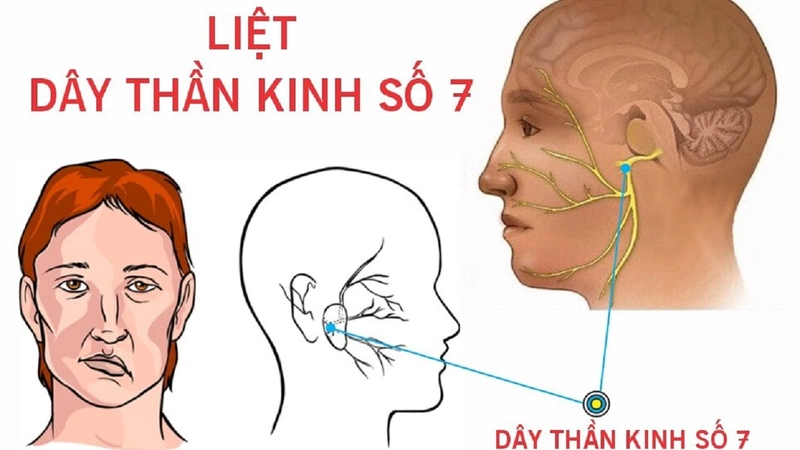 Liệt dây thần kinh số 7 là do dây thần kinh này bị chèn ép hoặc viêm nhiễm.