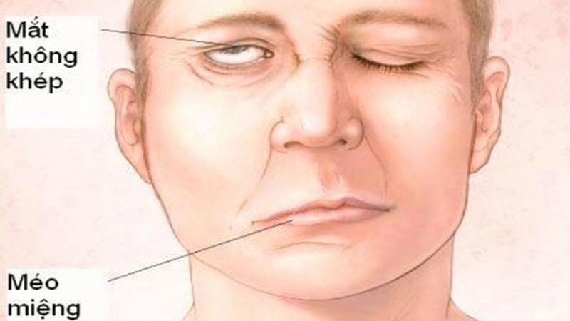 Liệt nửa mặt là một trong những biến chứng của liệt dây thần kinh số 7