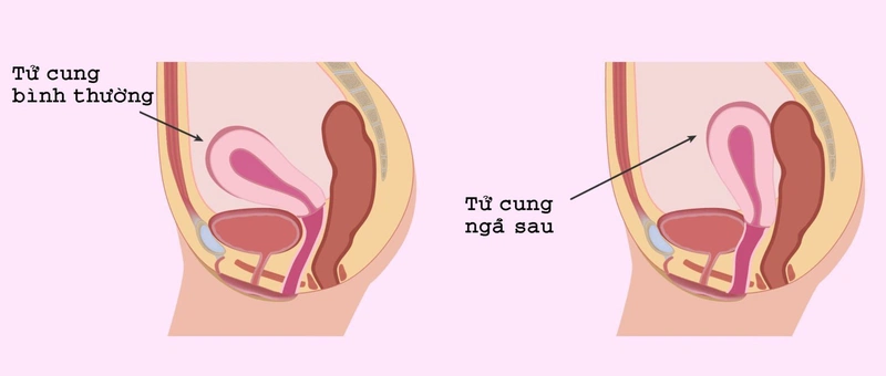 Tử cung ngả sau sinh con trai hay gái? Có ảnh hưởng gì đến thai nhi không?